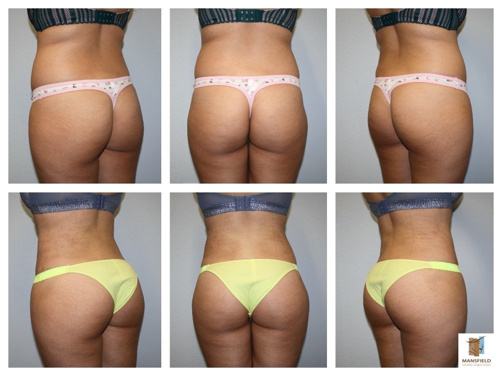 BBL Turkey before and after — 360 lipo body sculpting result