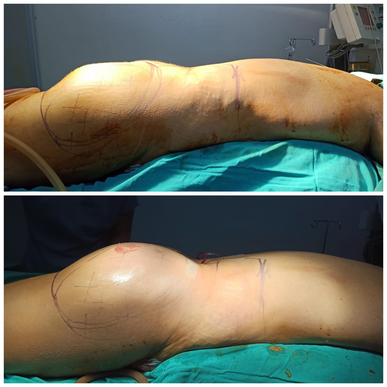 BBL Turkey Before and After Result 11
