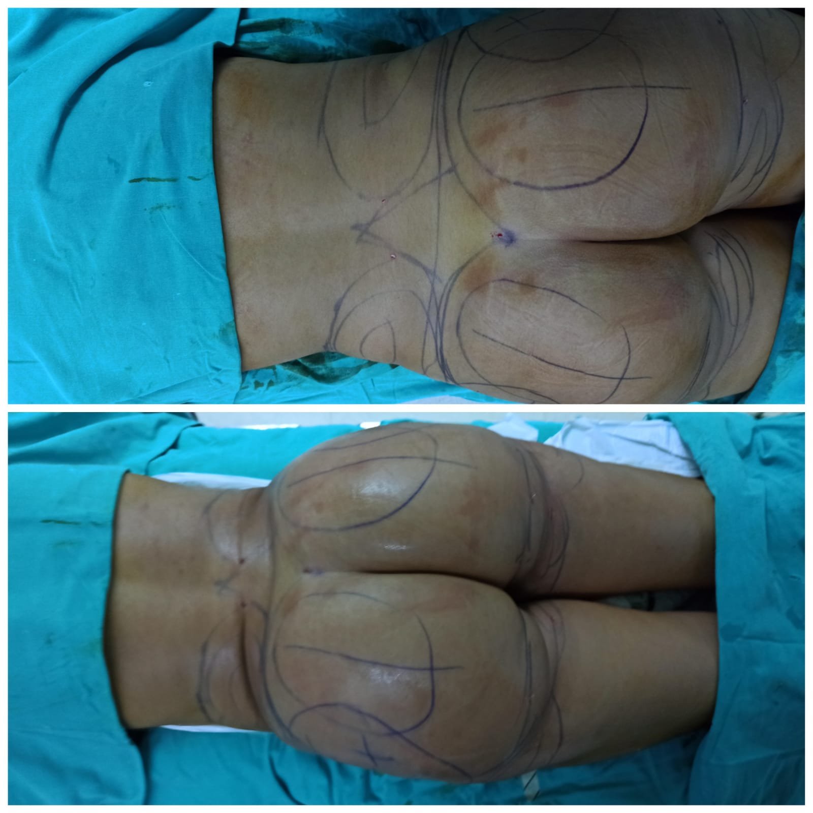BBL Turkey Before and After Result 12
