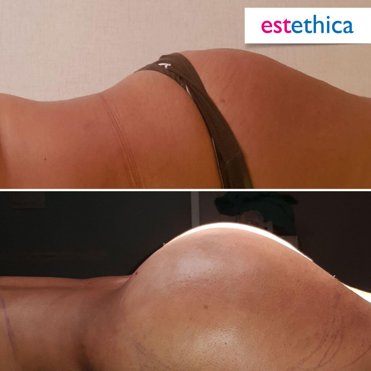 BBL Turkey Before and After Result 8