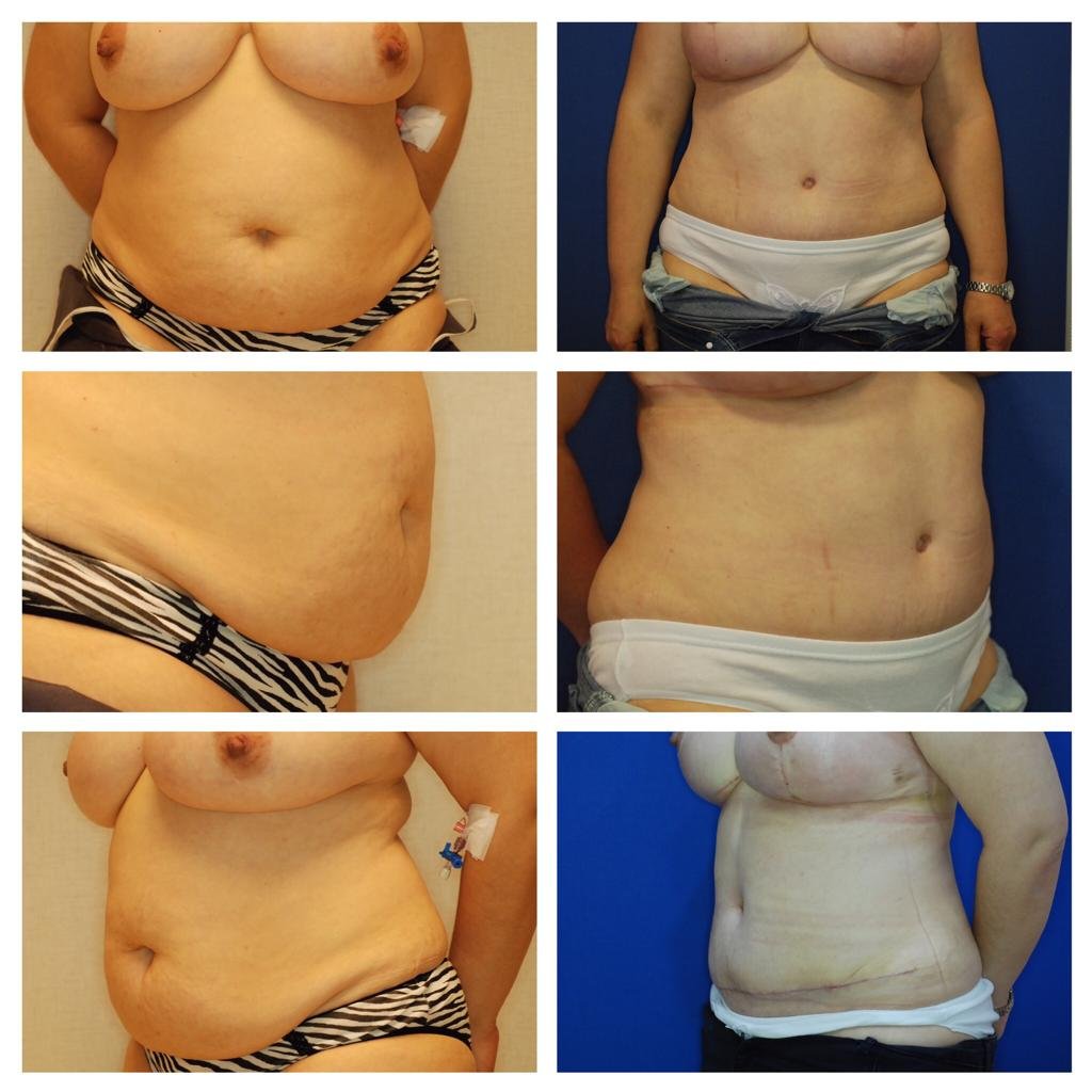 BBL Turkey Before and After Result 13