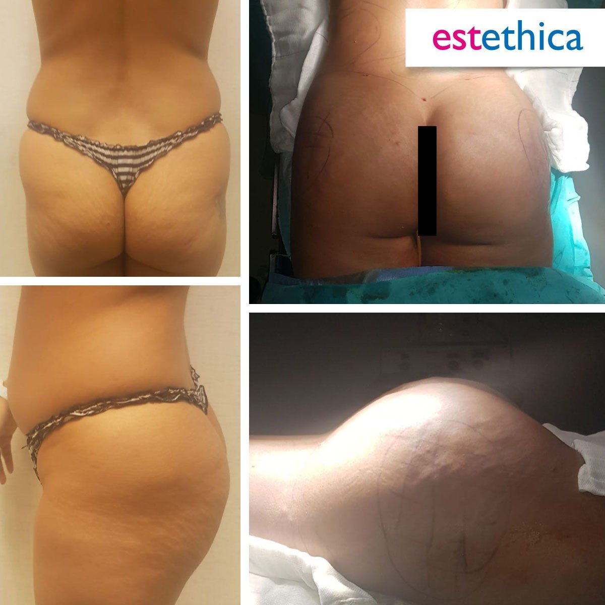 BBL Turkey Before and After Result 7