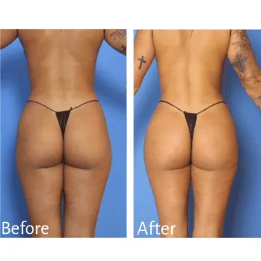 BBL Turkey Before and After Result 2