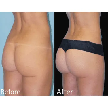 BBL Turkey before after gallery — patient transformation Istanbul