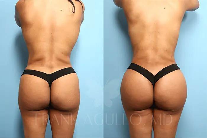 BBL Turkey before and after photo — buttock lift fat transfer