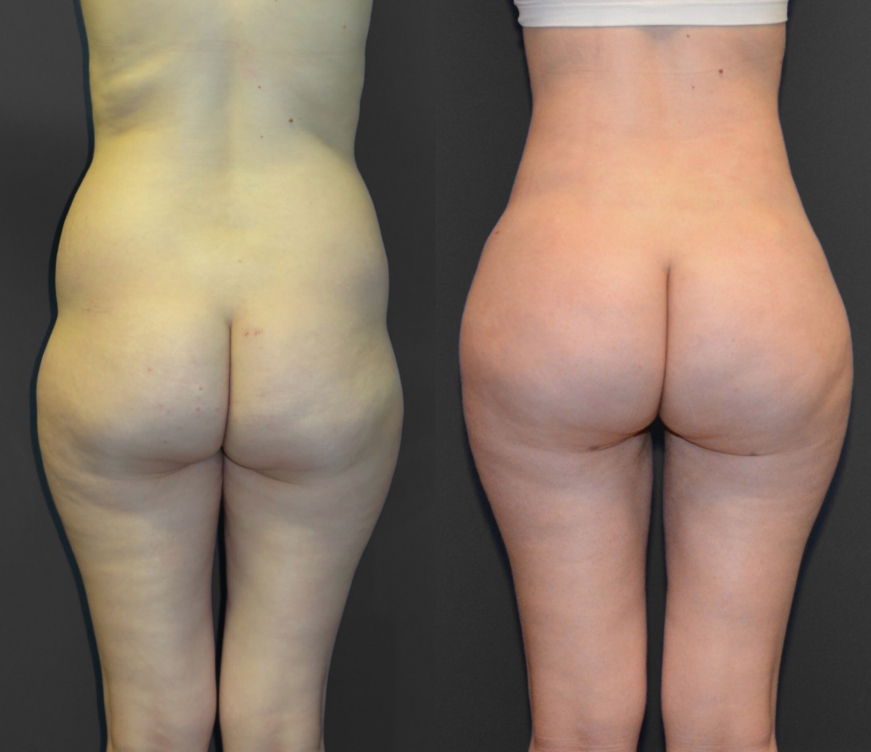 BBL Turkey Before and After Result 1