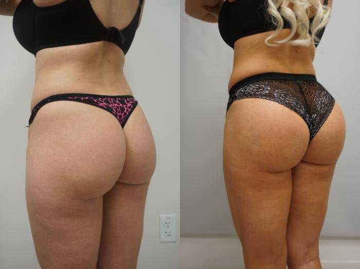 Brazilian buttock lift before and after Turkey — side view result