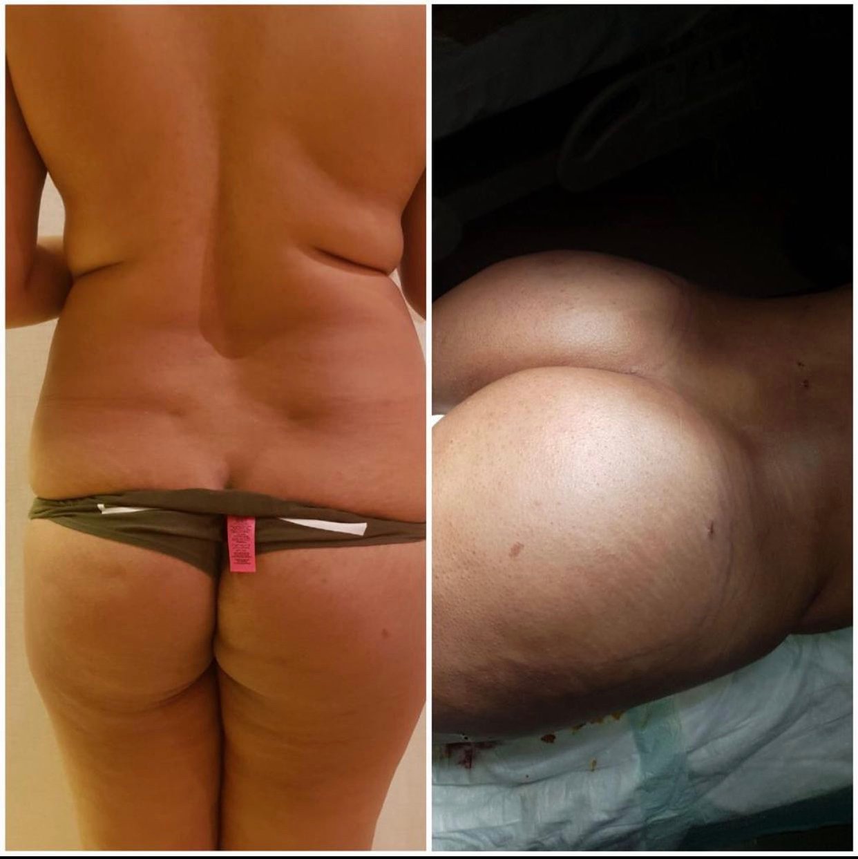 BBL Turkey Before and After Result 10