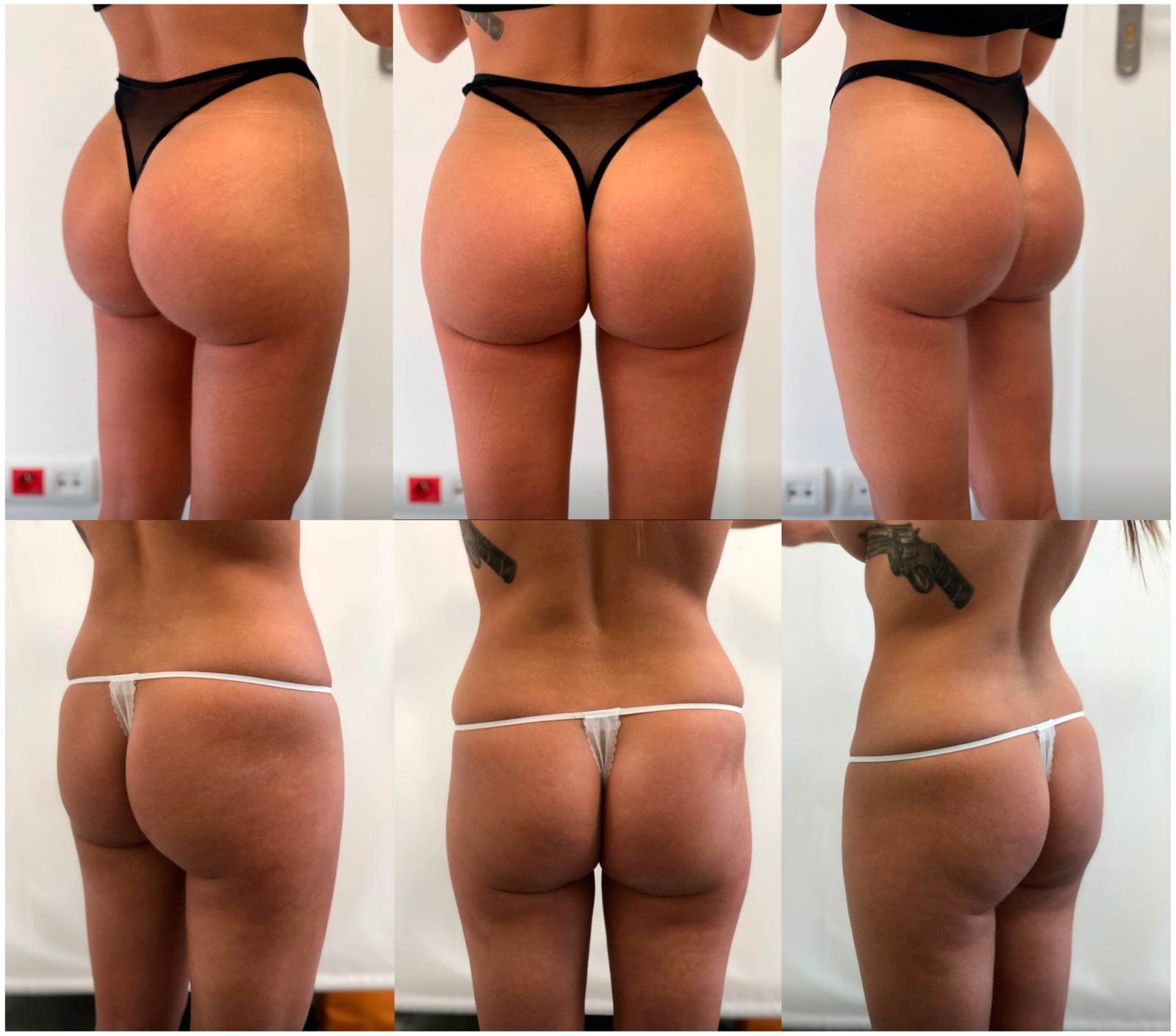 BBL Turkey Before and After Result 5