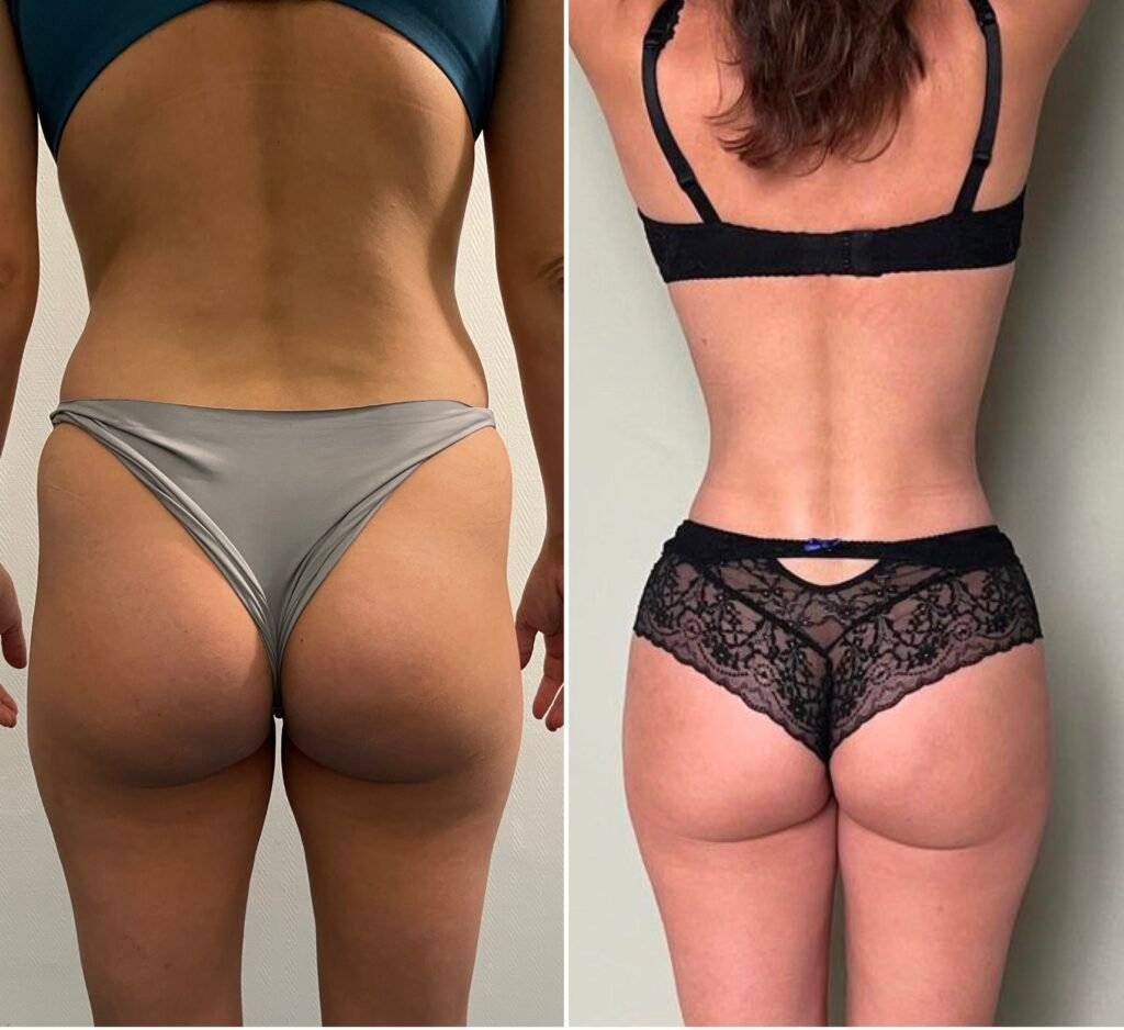 Liposuction love handles before after Turkey — flanks contouring